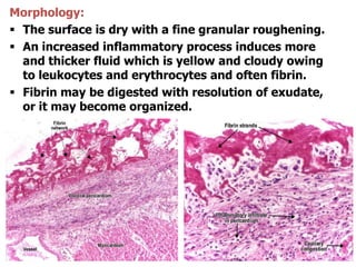 Morphology:
 The surface is dry with a fine granular roughening.
 An increased inflammatory process induces more
and thicker fluid which is yellow and cloudy owing
to leukocytes and erythrocytes and often fibrin.
 Fibrin may be digested with resolution of exudate,
or it may become organized.
 