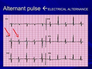 Alternant pulseAlternant pulse ELECTRICAL ALTERNANCEELECTRICAL ALTERNANCE
 