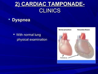 2) CARDIAC TAMPONADE-2) CARDIAC TAMPONADE-
CLINICSCLINICS
 DyspneaDyspnea
 With normal lungWith normal lung
physical examinationphysical examination
 