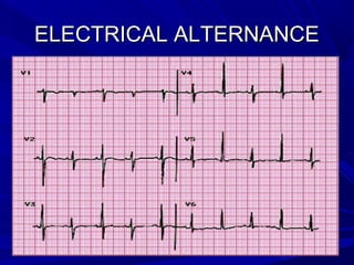 ELECTRICAL ALTERNANCEELECTRICAL ALTERNANCE
 