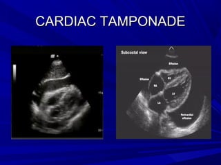 CARDIAC TAMPONADECARDIAC TAMPONADE
 