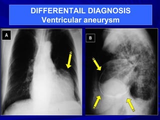 DIFFERENTAIL DIAGNOSIS
Ventricular aneurysm
 