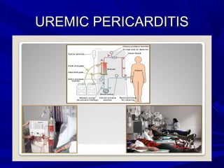 UREMIC PERICARDITISUREMIC PERICARDITIS
 