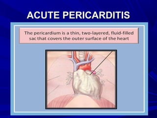 ACUTE PERICARDITISACUTE PERICARDITIS
 