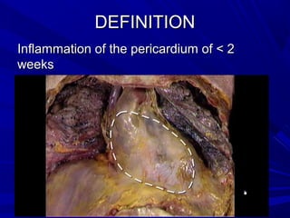 DEFINITIONDEFINITION
Inflammation of the pericardium of < 2Inflammation of the pericardium of < 2
weeksweeks
 