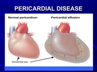 PERICARDIAL DISEASEPERICARDIAL DISEASE
 