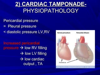 2) CARDIAC TAMPONADE-2) CARDIAC TAMPONADE-
PHYSIOPATHOLOGYPHYSIOPATHOLOGY
Pericardial pressurePericardial pressure
= Pleural pressure= Pleural pressure
< diastolic pressure LV,RV< diastolic pressure LV,RV
Increased pericardialIncreased pericardial
pressurepressure  low RV fillinglow RV filling
 low LV fillinglow LV filling
 low cardiaclow cardiac
output , TAoutput , TA
 