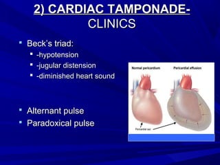 2) CARDIAC TAMPONADE-2) CARDIAC TAMPONADE-
CLINICSCLINICS
 Beck’s triad:Beck’s triad:
 -hypotension-hypotension
 -jugular distension-jugular distension
 -diminished heart sound-diminished heart sound
 Alternant pulseAlternant pulse
 Paradoxical pulseParadoxical pulse
 