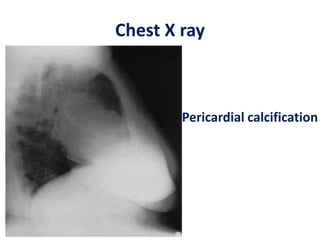 Chest X ray
Pericardial calcification
 