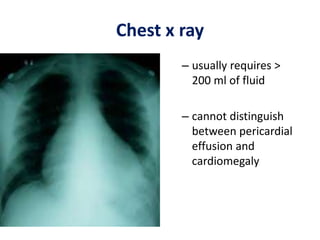 Chest x ray
– usually requires >
200 ml of fluid
– cannot distinguish
between pericardial
effusion and
cardiomegaly
 