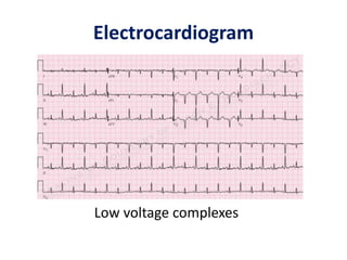 Electrocardiogram
Low voltage complexes
 