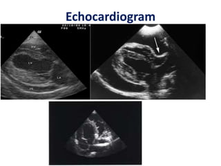 Echocardiogram
 