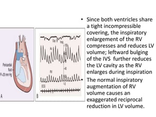 • Since both ventricles share
a tight incompressible
covering, the inspiratory
enlargement of the RV
compresses and reduces LV
volume; leftward bulging
of the IVS further reduces
the LV cavity as the RV
enlarges during inspiration
• The normal inspiratory
augmentation of RV
volume causes an
exaggerated reciprocal
reduction in LV volume.
 