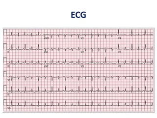 ECG
 