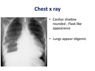 Chest x ray
• Cardiac shadow
rounded ; Flask like
appearance
• Lungs appear oligemic
 