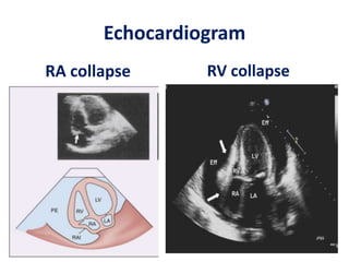 Echocardiogram
RA collapse RV collapse
 