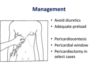 Management
• Avoid diuretics
• Adequate preload
• Pericardiocentesis
• Pericardial window
• Pericardiectomy in
select cases
 