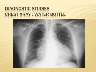 DIAGNOSTIC STUDIES
CHEST XRAY : WATER BOTTLE
 