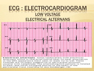 ECG : ELECTROCARDIOGRAM
LOW VOLTAGE
ELECTRICAL ALTERNANS
 