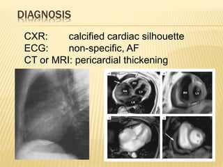 DIAGNOSIS
CXR: calcified cardiac silhouette
ECG: non-specific, AF
CT or MRI: pericardial thickening
 
