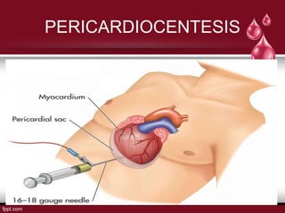 PERICARDIOCENTESIS
 