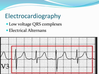 Electrocardiography
 Low voltage QRS complexes
 Electrical Alternans
 