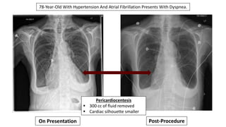 On Presentation
Pericardiocentesis
 300 cc of fluid removed
 Cardiac silhouette smaller
Post-Procedure
78-Year-Old With ...