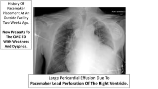 Large Pericardial Effusion Due To
Pacemaker Lead Perforation Of The Right Ventricle.
History Of
Pacemaker
Placement At An
Outside Facility
Two Weeks Ago.
Now Presents To
The CMC ED
With Weakness
And Dyspnea.
 