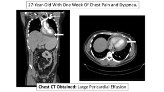 27-Year-Old With One Week Of Chest Pain and Dyspnea.
Chest CT Obtained: Large Pericardial Effusion
 