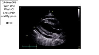 27-Year-Old
With One
Week Of
Chest Pain
and Dyspnea.
ECHO
 