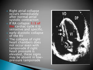 Pericardial effusion final | PPTX