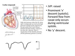 • JVP: raised
• Prominent ‘x’
descent (systolic).
Forward flow from
cavae only occurs
during ventricular
systole.
• No ‘y’ descent.
 