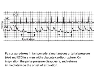 Pulsus paradoxus in tamponade: simultaneous arterial pressure
(Ao) and ECG in a man with subacute cardiac rupture. On
inspiration the pulse pressure disappears, and returns
immediately on the onset of expiration.
 