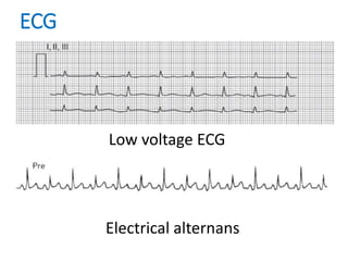 ECG
Low voltage ECG
Electrical alternans
 