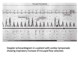 Doppler echocardiogram in a patient with cardiac tamponade
showing inspiratory increase of tricuspid flow velocities
 