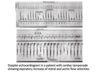 Doppler echocardiogram in a patient with cardiac tamponade
showing expiratory increase of mitral and aortic flow velocities.
 
