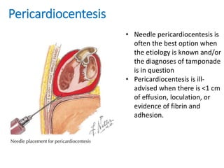 Pericardiocentesis
• Needle pericardiocentesis is
often the best option when
the etiology is known and/or
the diagnoses of tamponade
is in question
• Pericardiocentesis is ill-
advised when there is <1 cm
of effusion, loculation, or
evidence of fibrin and
adhesion.
 