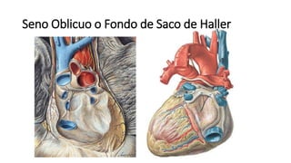 Seno Oblicuo o Fondo de Saco de Haller
