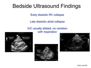 Bedside Ultrasound Findings
Early diastolic RV collapse
Late diastolic atrial collapse
IVC usually dilated, no variation
with respiration
Nikita Joshi MD
 