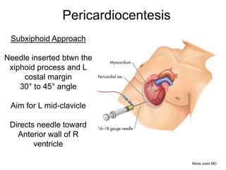 Subxiphoid Approach
Needle inserted btwn the
xiphoid process and L
costal margin
30° to 45° angle
Aim for L mid-clavicle
Directs needle toward
Anterior wall of R
ventricle
Pericardiocentesis
Nikita Joshi MD
 