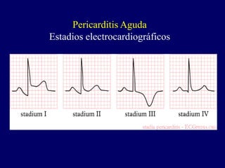 Pericarditis Aguda
Estadios electrocardiográficos
 