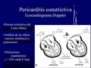 Pericarditis constrictiva
                   Ecocardiograma Doppler

•Patente restrictiva del                    EA
      Lleno Mitral

•Análisis de los flujos
 venosos sistémicos y
pulmonares


•Variaciones
      respiratorias
↓ > 25% onda E insp
 