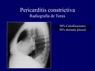Pericarditis constrictiva
    Radiografía de Torax

                    50% Calcificaciones
                    50% derrame pleural
 