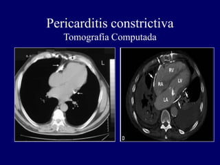 Pericarditis constrictiva
   Tomografía Computada
 