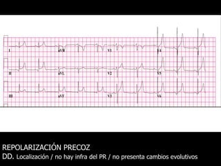 REPOLARIZACIÓN PRECOZ
DD. Localización / no hay infra del PR / no presenta cambios evolutivos
 