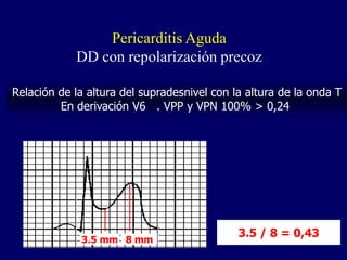 Pericarditis Aguda
            DD con repolarización precoz

Relación de la altura del supradesnivel con la altura de la onda T
         En derivación V6 . VPP y VPN 100% > 0,24




                                             3.5 / 8 = 0,43
             3.5 mm 8 mm
 