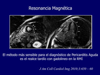 Resonancia Magnética




El método más sensible para el diagnóstico de Pericarditis Aguda
           es el realce tardío con gadolineo en la RMI

                        J Am Coll Cardiol Img 2010;3:650 – 60
 