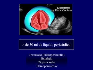 > de 50 ml de liquido pericárdico

    Trasudado (Hidropericardio)
             Exudado
           Piopericardio
          Hemopericardio
 