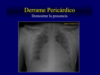 Derrame Pericárdico
  Demostrar la presencia
 