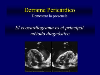 Derrame Pericárdico
       Demostrar la presencia


El ecocardiograma es el principal
       método diagnóstico
 